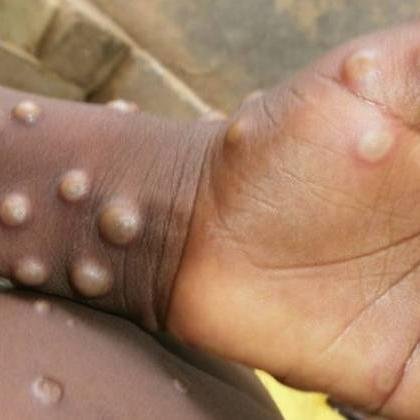 Angola não registou ainda casos de Varíola do Macaco